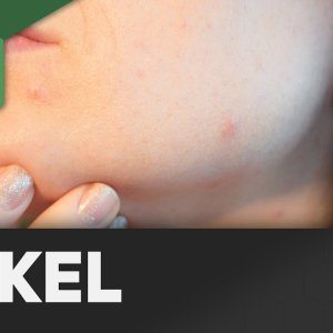 TIPPS+HAUT+WIMMERL: Pickel - Wie entstehen sie? (DE 2015)