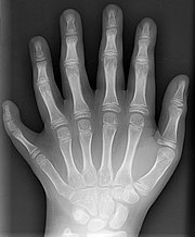 180px-Polydactyly_01_Lhand_AP.jpg